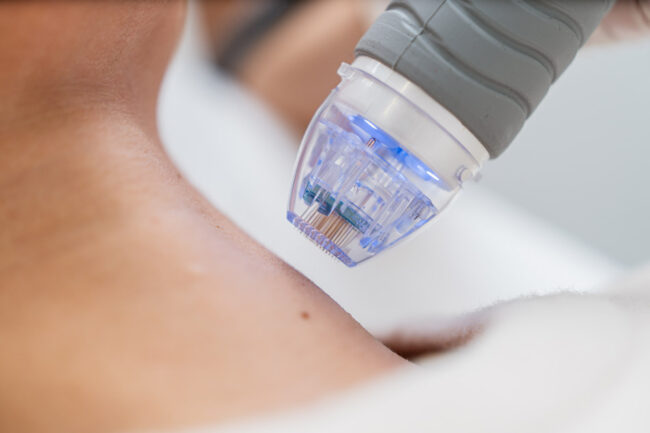 Microneedling
